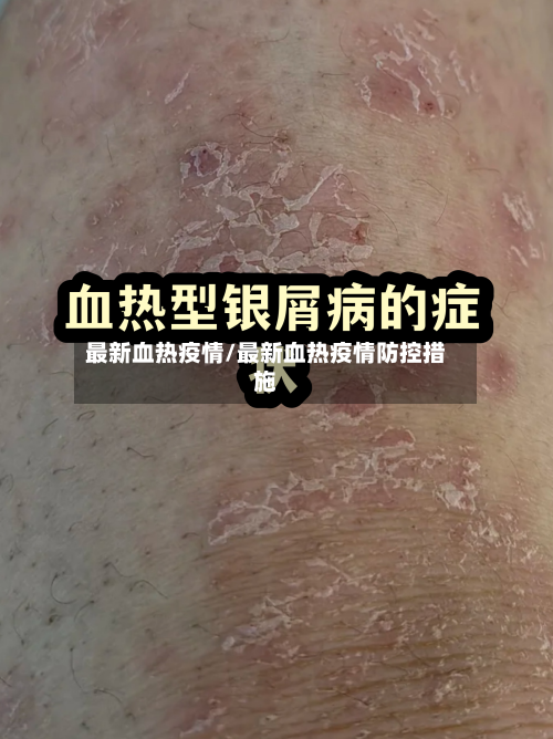 最新血热疫情/最新血热疫情防控措施