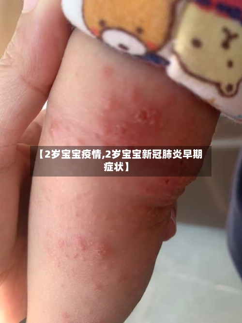 【2岁宝宝疫情,2岁宝宝新冠肺炎早期症状】-第2张图片